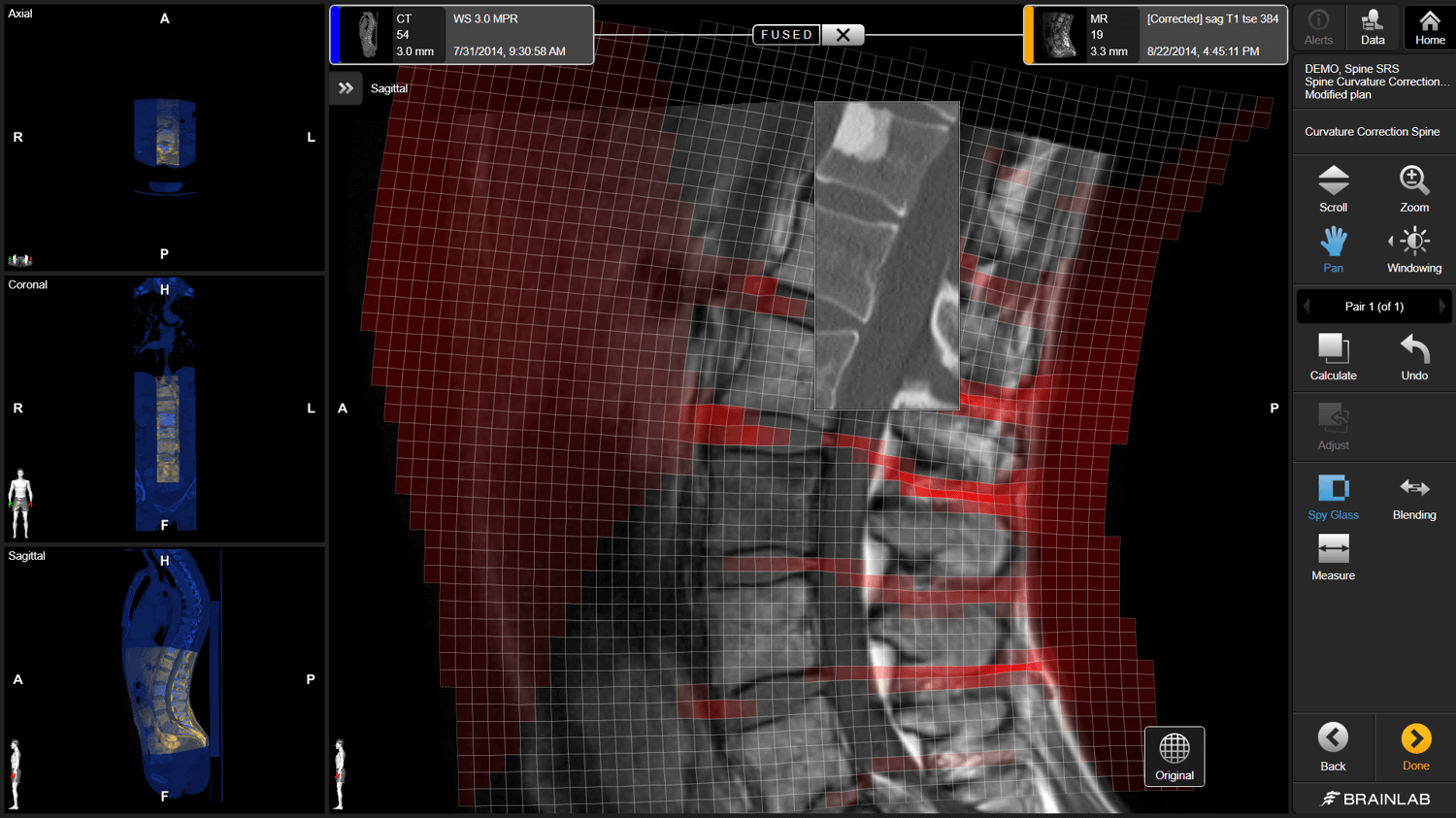 マスターテクニックRelevant Surgical Exposures 第2版 Benzel's Spine Surgery, 2-Volume Set: Techniques